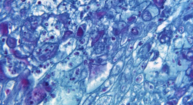 Variole du singe : plus de 6.000 cas signalés dans le monde dont 80 % en Europe - OMS
